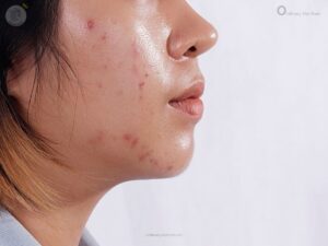 Da dầu mụn Ordinary Viet Nam